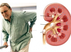 Những dấu hiệu nhận biết bệnh thận bạn không nên bỏ qua